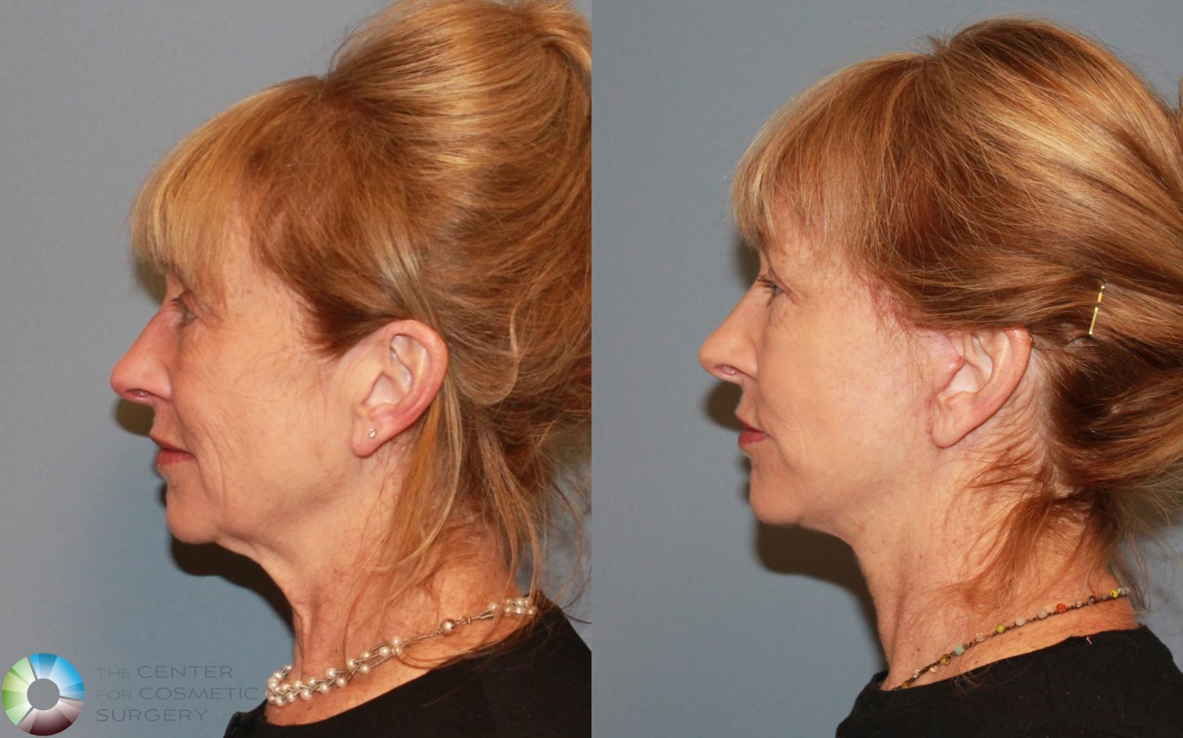 Before & After Mini Facelift Case 476 View #3 View in Golden, CO