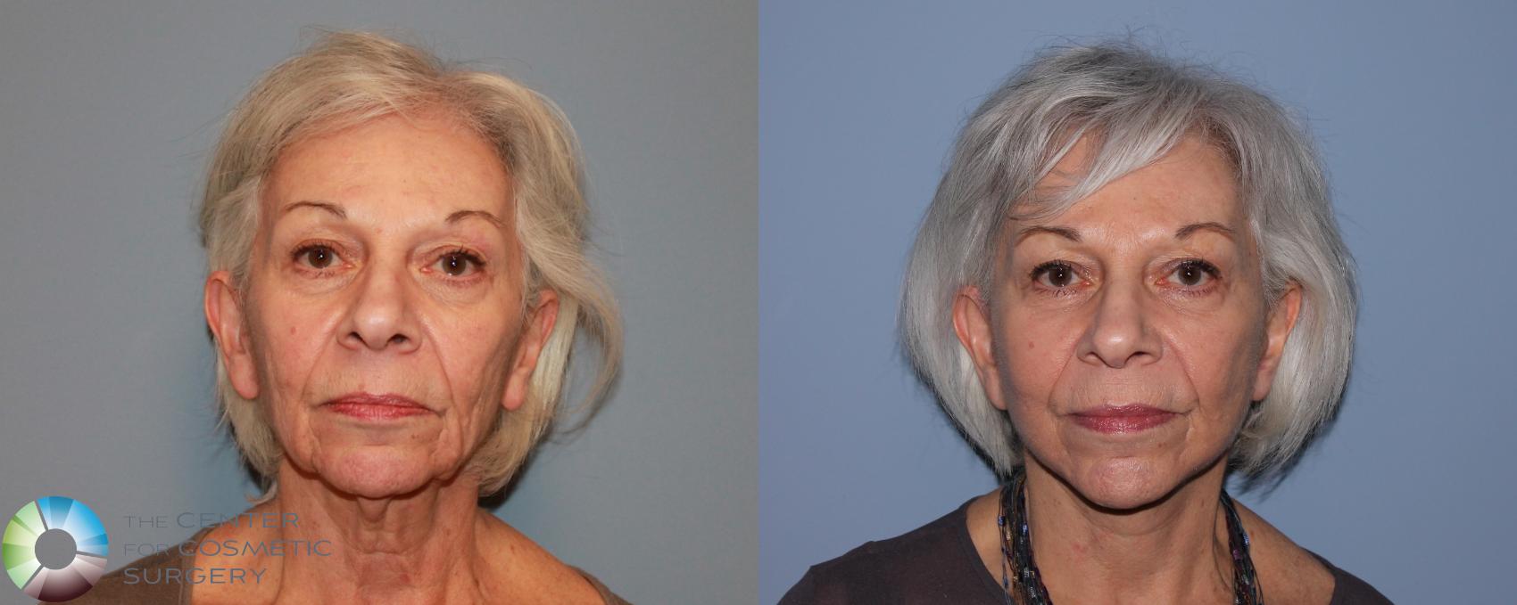 Before & After Facelift Case 480 View #1 in Denver and Colorado Springs, CO