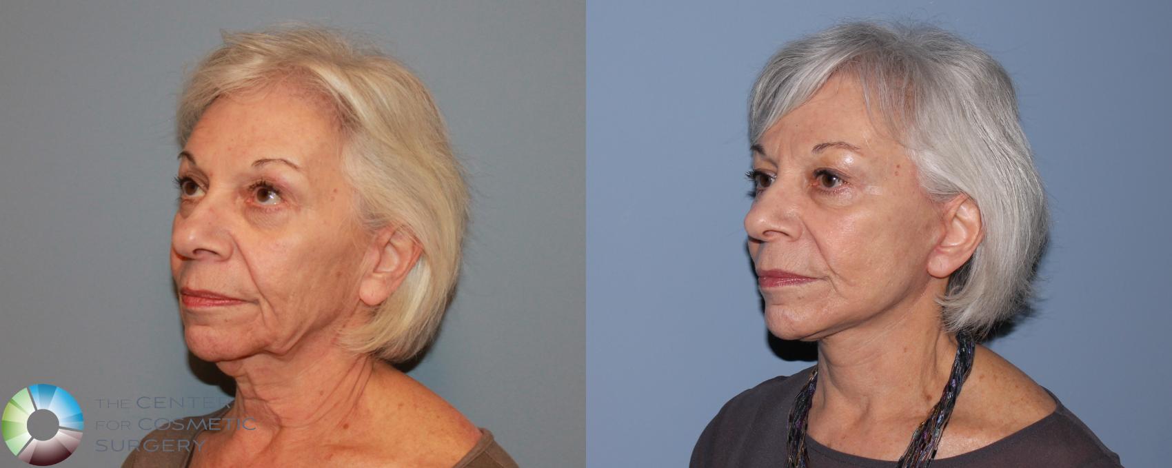 Before & After Mini Facelift Case 480 View #2 View in Golden, CO
