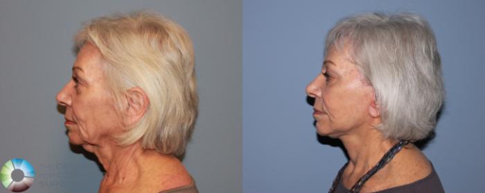 Before & After Mini Facelift Case 480 View #3 View in Golden, CO