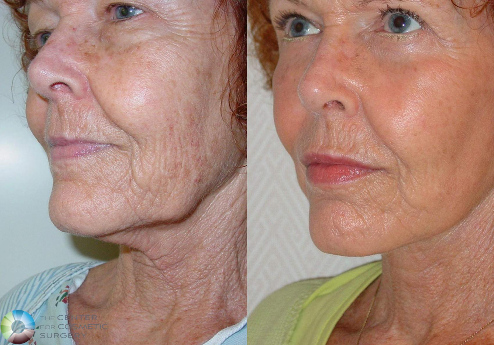 Before & After Facelift Case 498 View #1 in Denver and Colorado Springs, CO