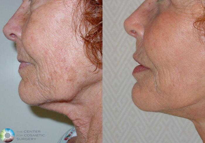Before & After Mini Facelift Case 498 View #2 View in Golden, CO