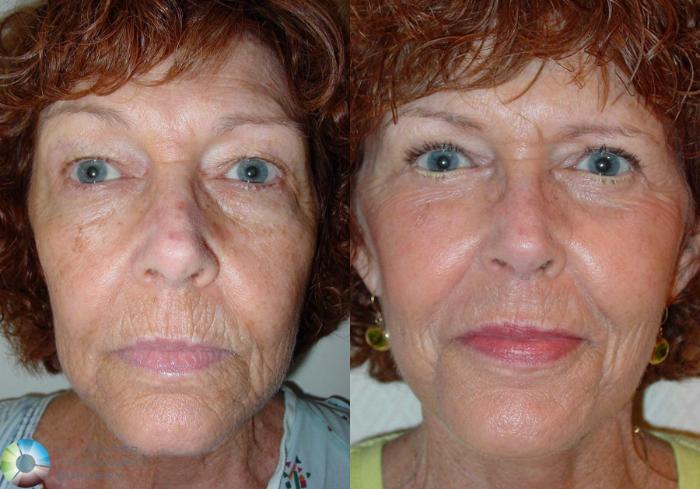 Before & After Mini Facelift Case 498 View #3 View in Golden, CO