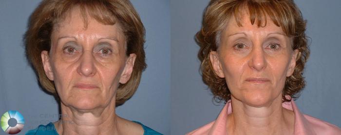 Before & After Mini Facelift Case 55 View #1 View in Golden, CO