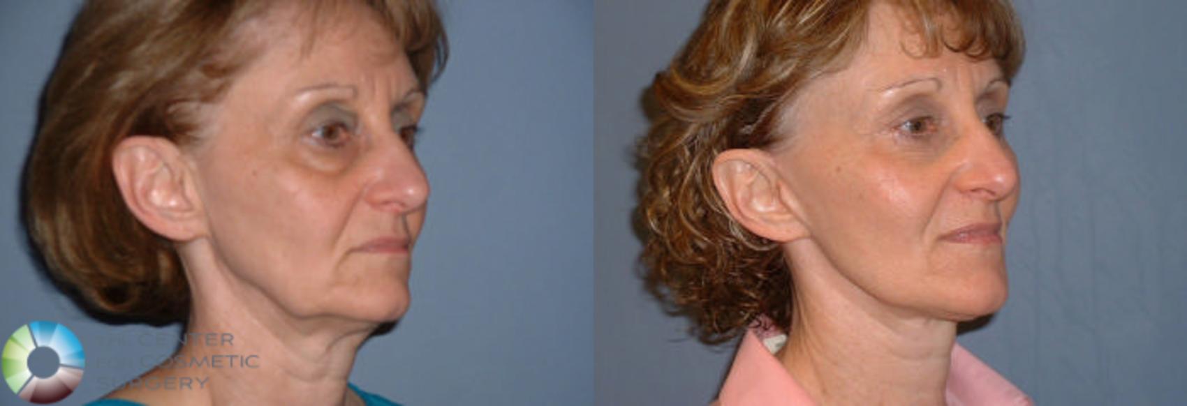 Before & After Mini Facelift Case 55 View #2 View in Golden, CO