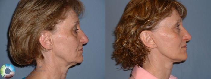 Before & After Mini Facelift Case 55 View #3 View in Golden, CO