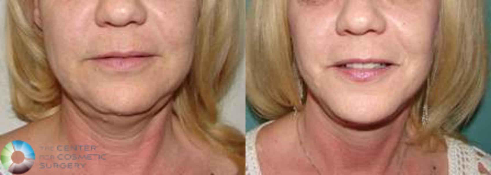 Before & After Neck Lift Case 618 View #1 in Denver and Colorado Springs, CO