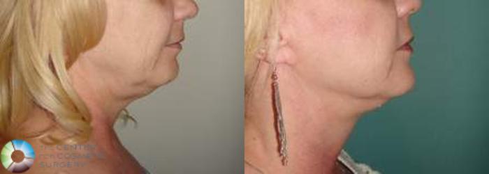 Before & After Mini Facelift Case 618 View #3 View in Golden, CO