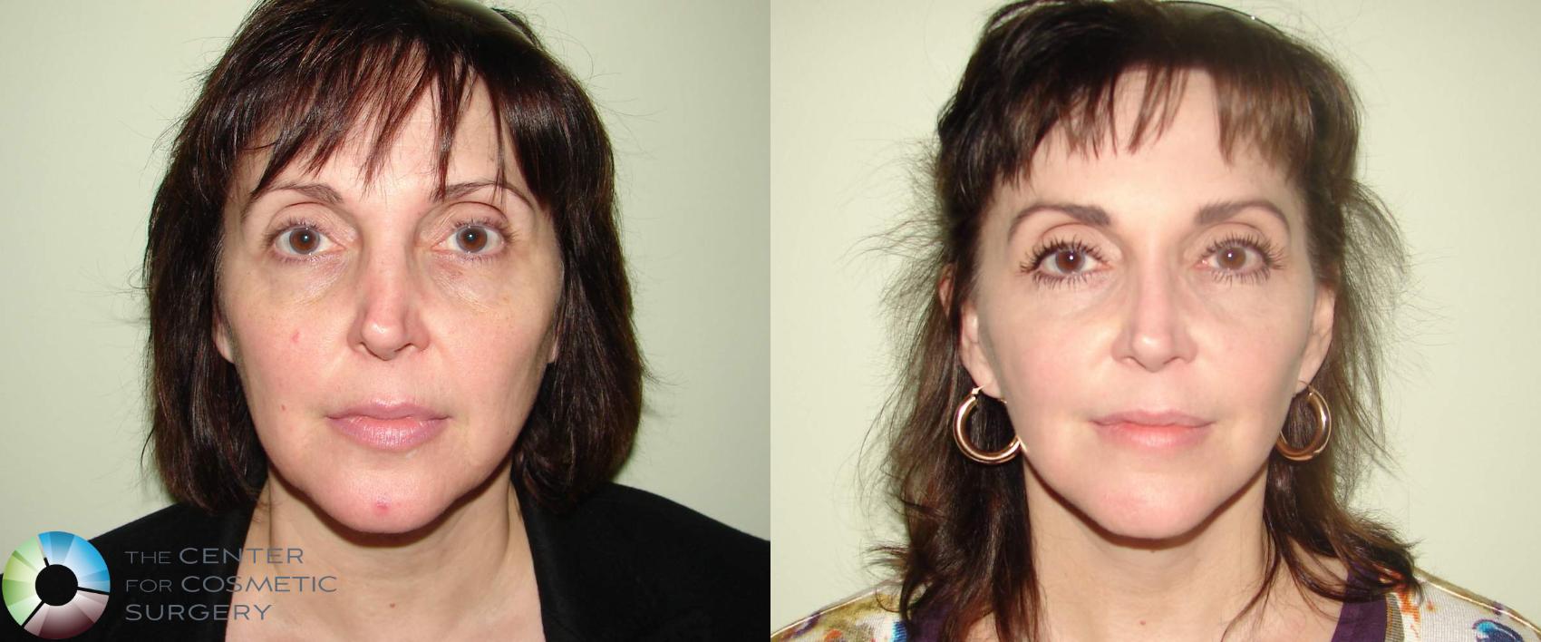 Before & After Mini Facelift Case 654 View #1 in Denver and Colorado Springs, CO