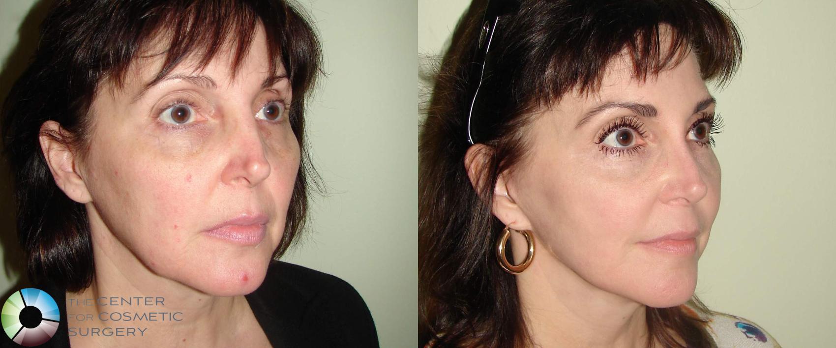 Before & After Mini Facelift Case 654 View #2 View in Golden, CO