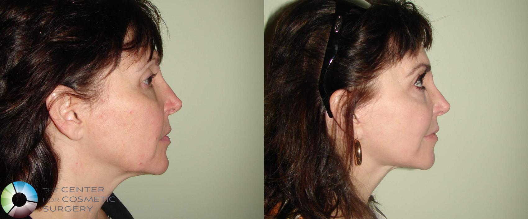 Before & After Mini Facelift Case 654 View #3 View in Golden, CO