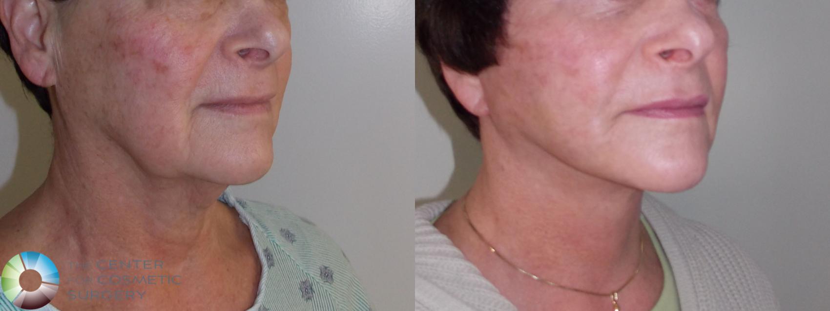Before & After Mini Facelift Case 680 View #1 in Denver and Colorado Springs, CO