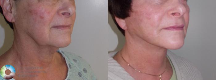Best Denver Mini-Facelift/Neck Lift