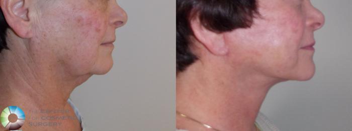 Before & After Mini Facelift Case 680 View #2 in Denver and Colorado Springs, CO