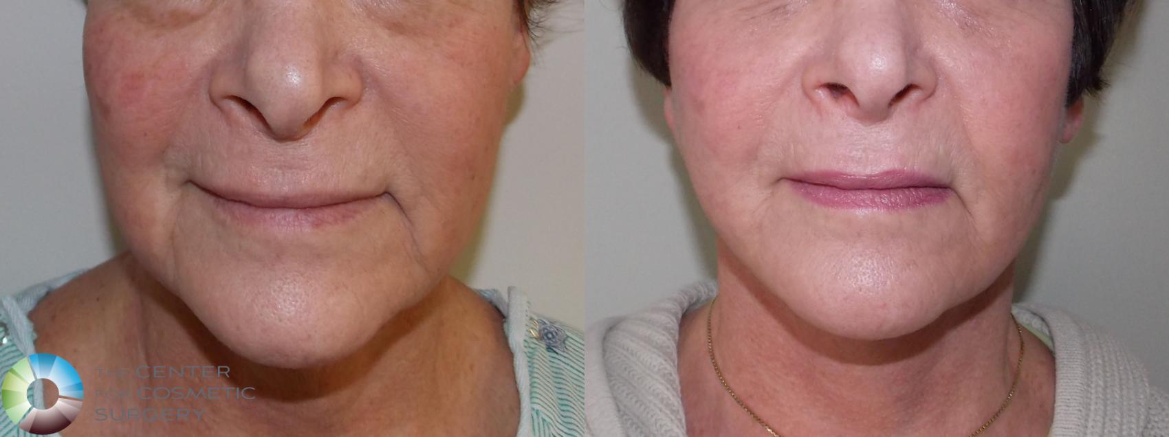 Before & After Mini Facelift Case 680 View #3 in Denver and Colorado Springs, CO