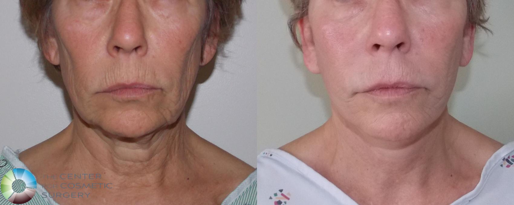 Before & After Mini Facelift Case 681 View #1 in Denver and Colorado Springs, CO
