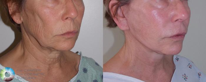Before & After Mini Facelift Case 681 View #2 in Denver and Colorado Springs, CO