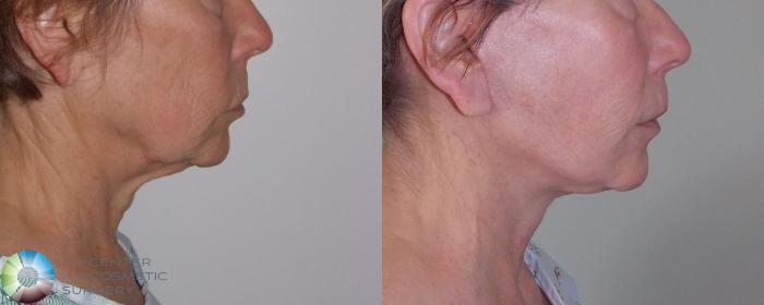 Before & After Mini Facelift Case 681 View #3 in Denver and Colorado Springs, CO