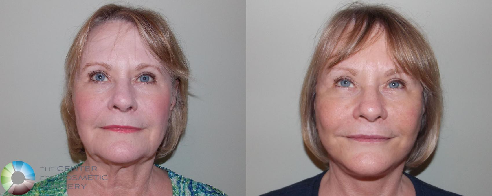 Before & After Facelift Case 687 View #1 in Denver and Colorado Springs, CO