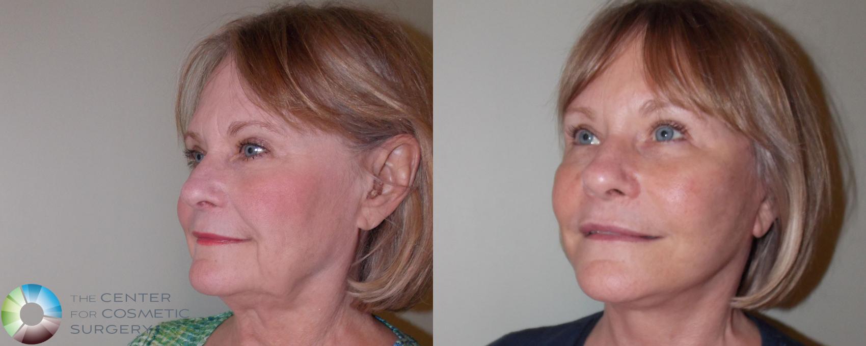 Before & After Mini Facelift Case 687 View #2 in Denver and Colorado Springs, CO