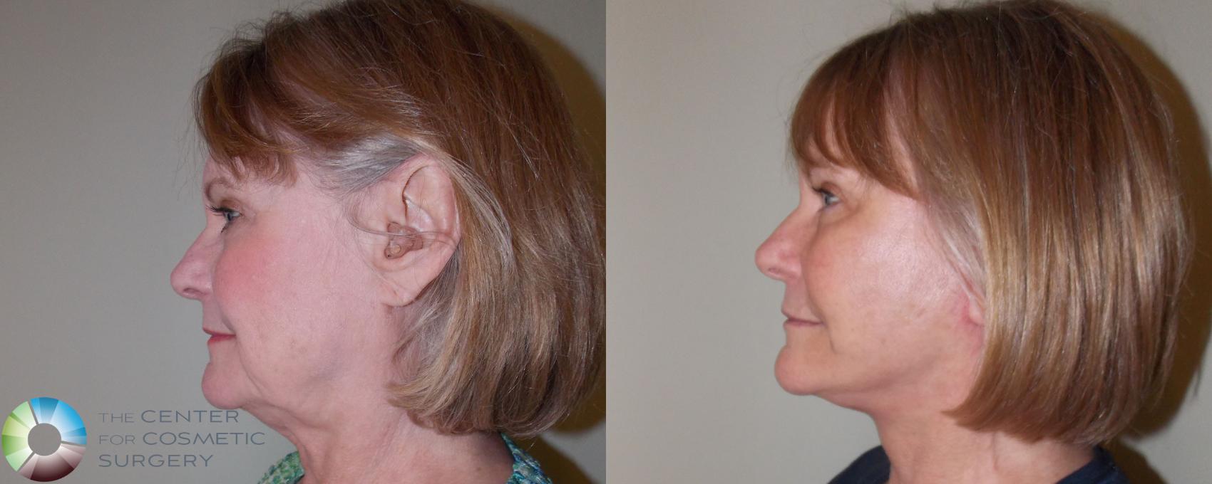 Before & After Mini Facelift Case 687 View #3 in Denver and Colorado Springs, CO