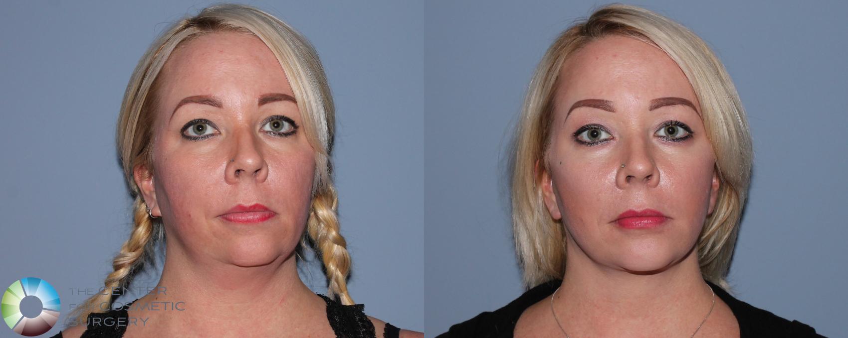 Before & After Mini Facelift Case 750 View #1 in Denver and Colorado Springs, CO