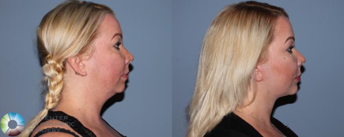 Before & After Facelift Case 750 View #2 in Denver and Colorado Springs, CO