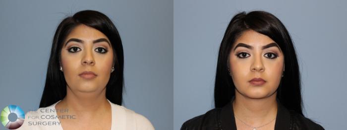 Before & After Mini Facelift Case 751 View #1 in Denver and Colorado Springs, CO
