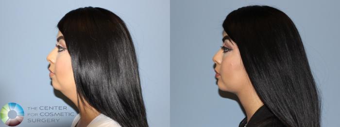 Before & After Neck Lift Case 751 View #2 in Denver and Colorado Springs, CO