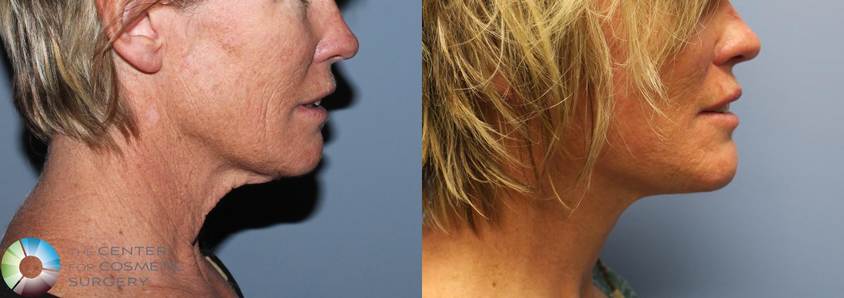 Before & After Mini Facelift Case 771 View #1 View in Golden, CO