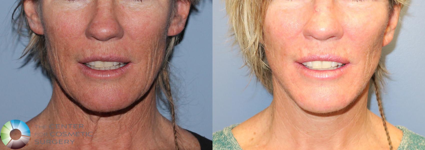 Before & After Mini Facelift Case 771 View #3 View in Denver & Golden, CO