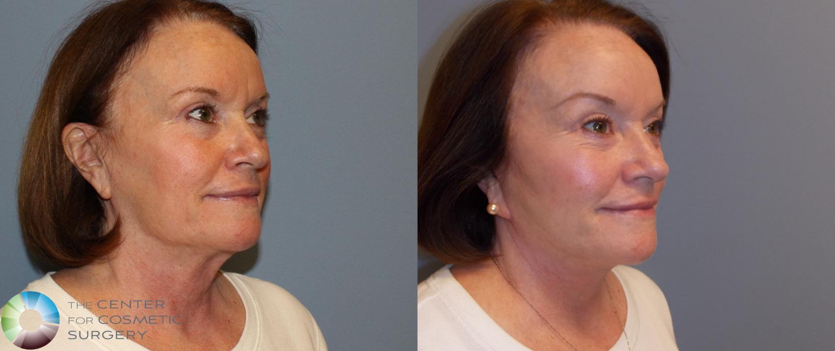 Before & After Facelift Case 772 View #1 in Denver and Colorado Springs, CO