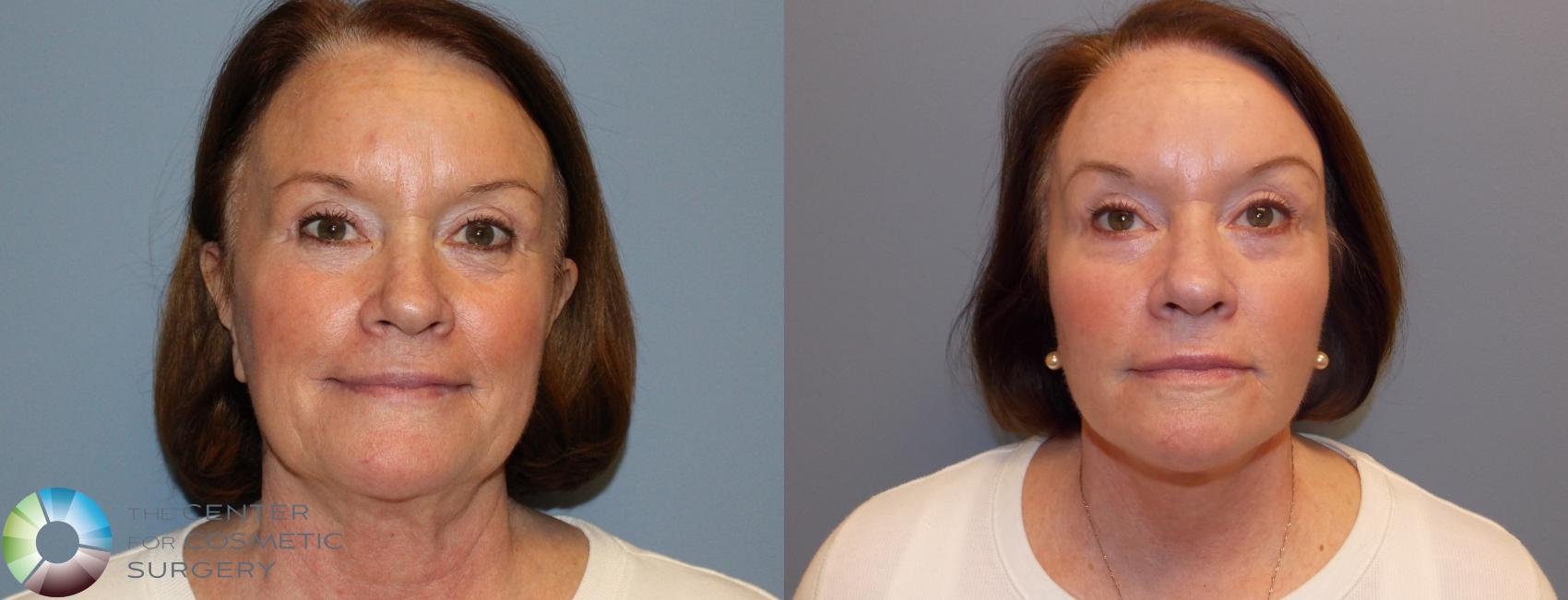 Before & After Mini Facelift Case 772 View #2 View in Golden, CO