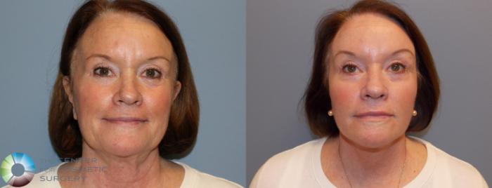 Before & After Mini Facelift Case 772 View #2 in Denver, CO