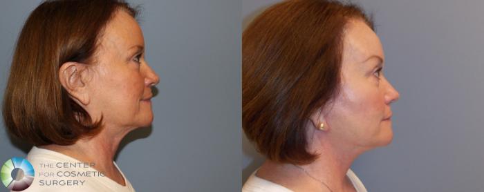 Before & After Mini Facelift Case 772 View #3 in Denver, CO