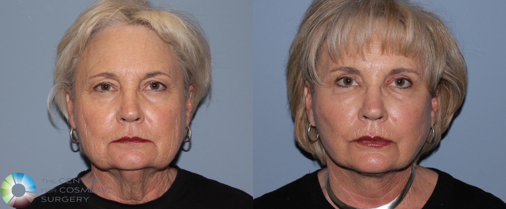 Before & After Mini Facelift Case 773 View #3 in Denver, CO