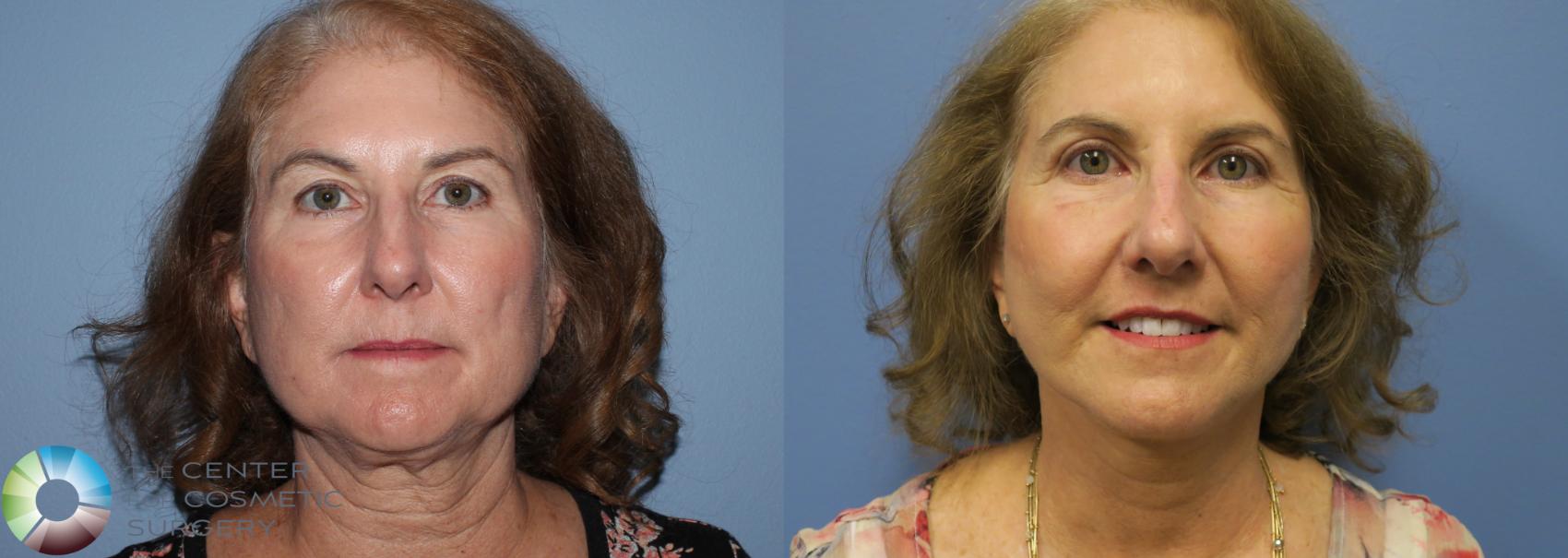 Before & After Facelift Case 774 View #1 in Denver and Colorado Springs, CO