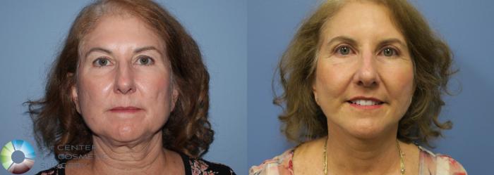 Before & After Mini Facelift Case 774 View #1 View in Golden, CO