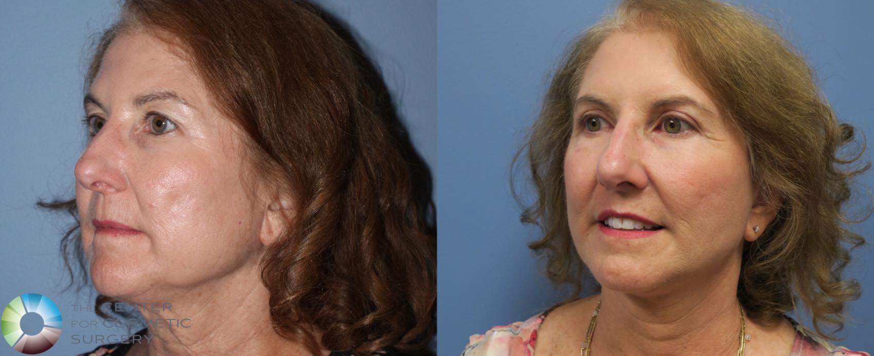 Before & After Mini Facelift Case 774 View #2 in Denver and Colorado Springs, CO