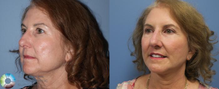 Before & After Mini Facelift Case 774 View #2 View in Golden, CO