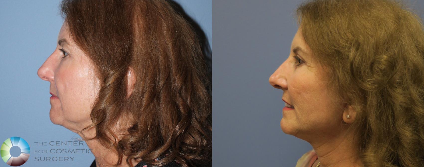 Before & After Mini Facelift Case 774 View #3 in Denver and Colorado Springs, CO