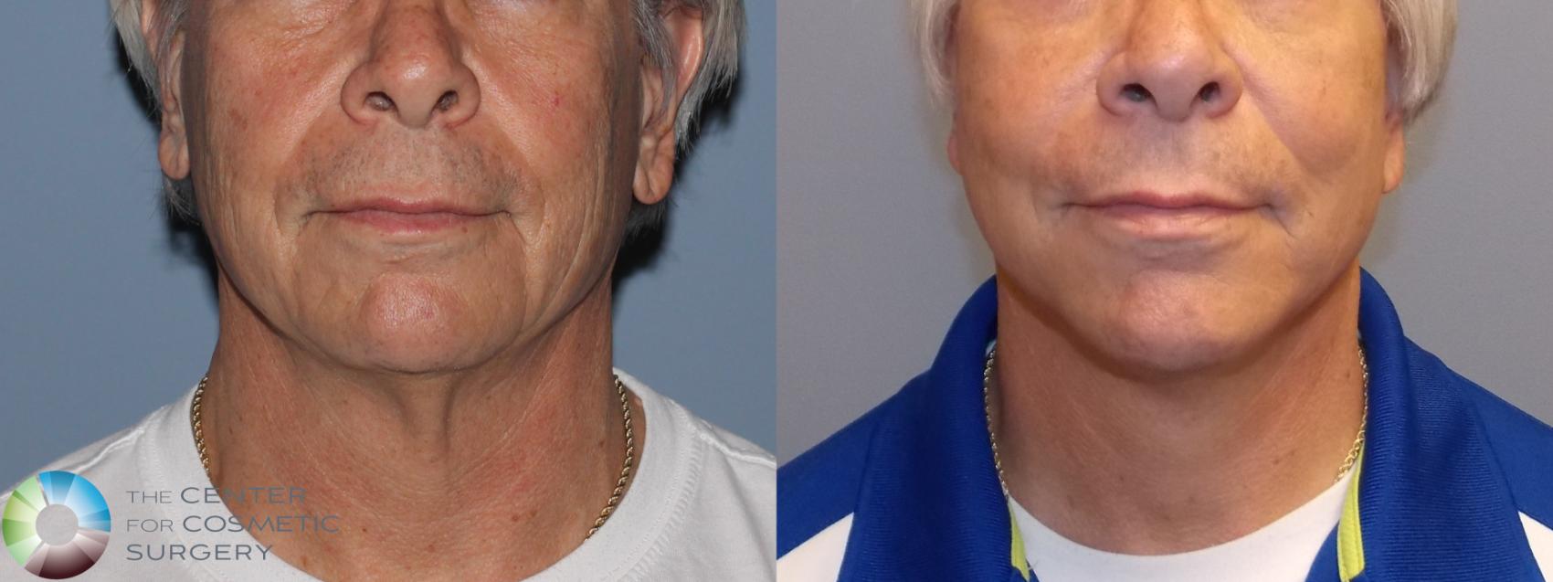 Before & After Mini Facelift Case 775 View #1 View in Golden, CO