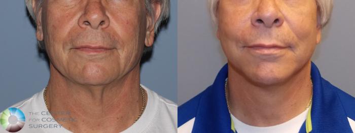 Before & After Mini Facelift Case 775 View #1 in Denver and Colorado Springs, CO