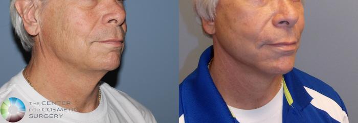 Before & After Mini Facelift Case 775 View #2 in Denver and Colorado Springs, CO
