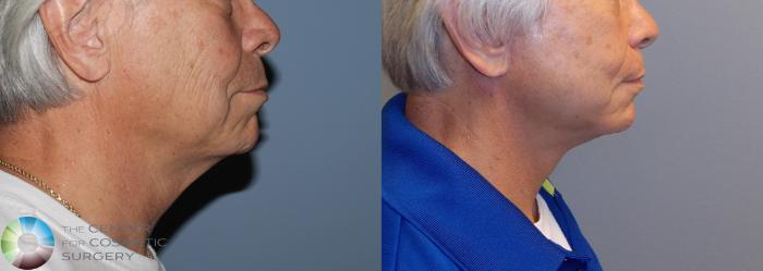 Before & After Mini Facelift Case 775 View #3 in Denver and Colorado Springs, CO