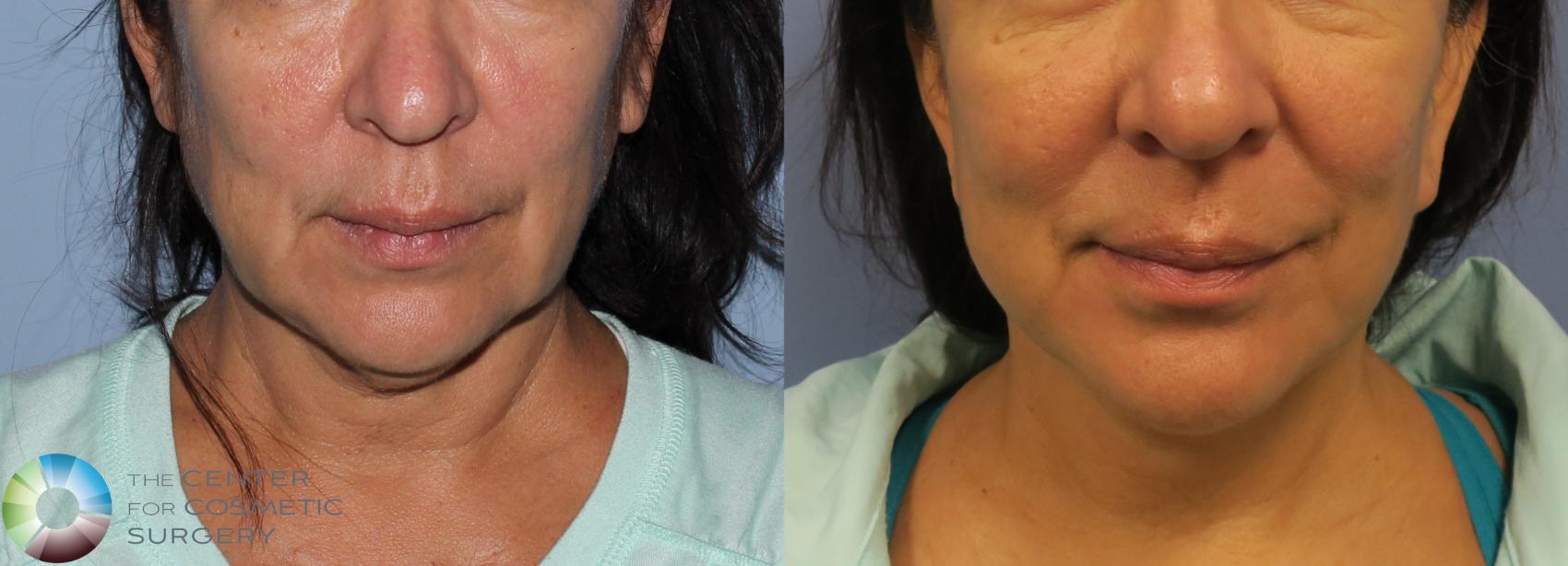 Before & After Mini Facelift Case 776 View #1 in Denver and Colorado Springs, CO