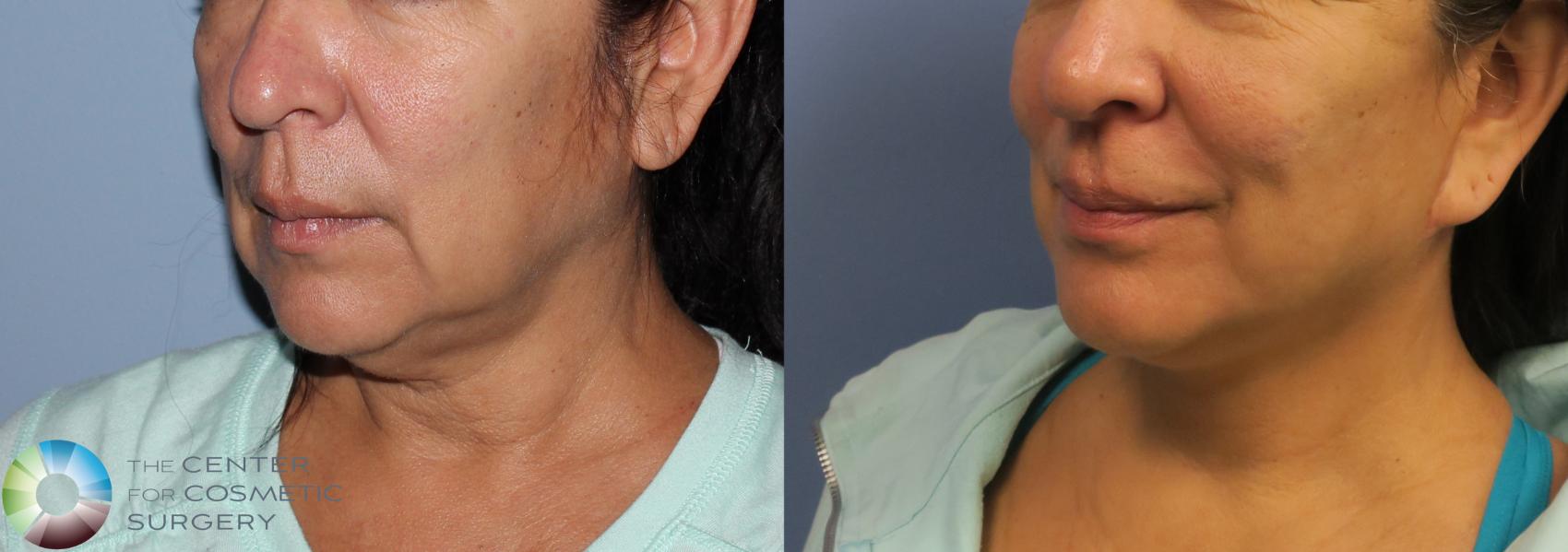 Before & After Mini Facelift Case 776 View #2 View in Golden, CO