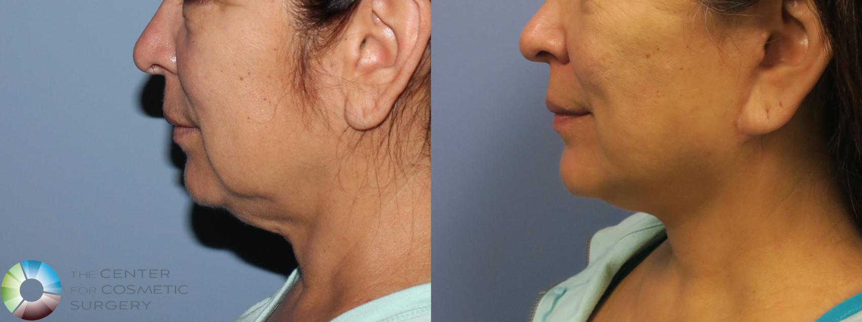 Before & After Mini Facelift Case 776 View #3 View in Golden, CO
