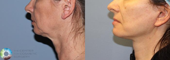 Before & After Mini Facelift Case 786 View #1 in Denver, CO