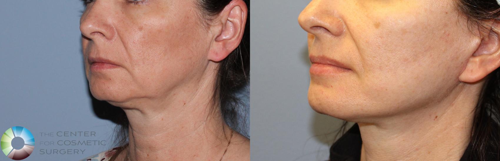 Before & After Mini Facelift Case 786 View #2 in Denver and Colorado Springs, CO